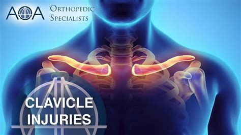 Aoa Orthopedic Specialists Clavicle Injuries Youtube