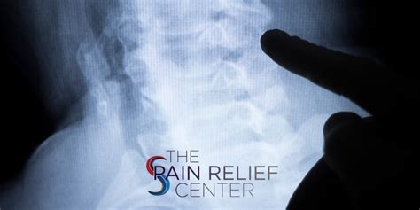 Stellate Ganglion Block | The Pain Relief Center | Nerve Pain Relief