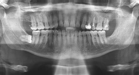 dental  rays radiographs hasenfus family dental