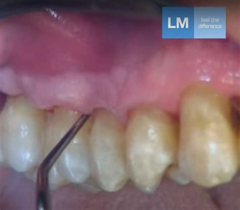 Clinical Use Of Gracey A Finishing Curette For Subgingival