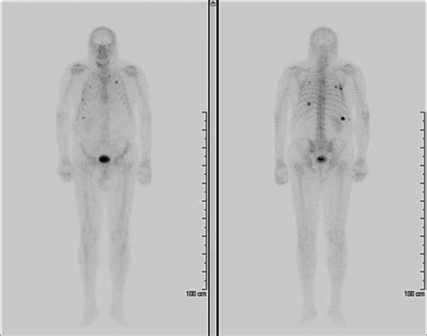 Bone scan showing stability of disease. | Download Scientific Diagram