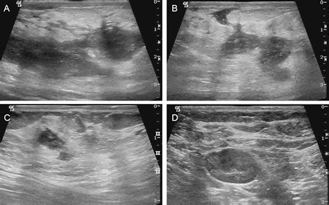 References In Chronic Granulomatous Mastitis Imaging Pathology And