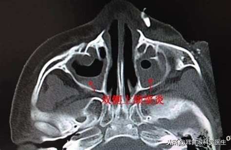慢性鼻 鼻竇炎的診斷和治療指南 每日頭條