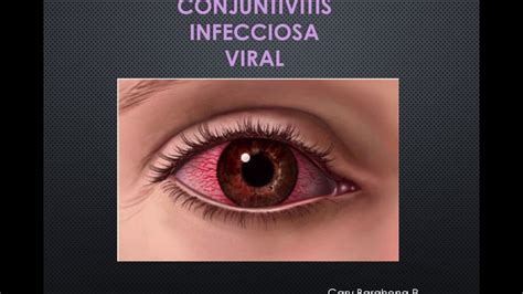 Conjuntivitis Viral Por Dario Barahona Youtube