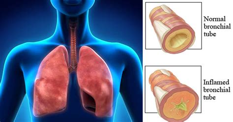 How To Get Rid Of Phlegm And Mucus In Chest And Throat Instant Result