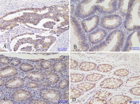 Immunohistochemical Micrographs Of β Catenin In Different Colorectal Download Scientific