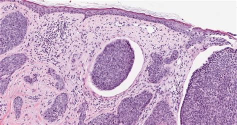 Squamous Cell Carcinoma Vs Basal Cell Carcinoma Histology