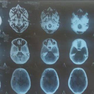 NCCT Brain depicting calcified granulomas are present in bilateral ...