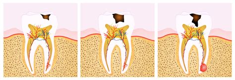 Tooth Decay Diagram