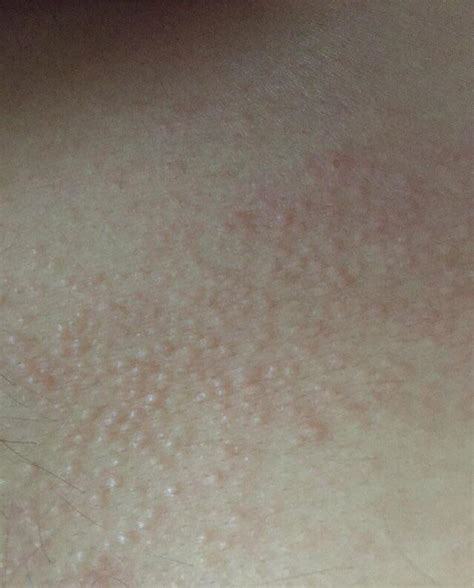 Itchy bumps on chest, abdomen, back of neck, and lower back. Someone please help. : r/Dermatology