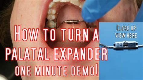 Tutorial How To Turn A Palatal Expander Youtube