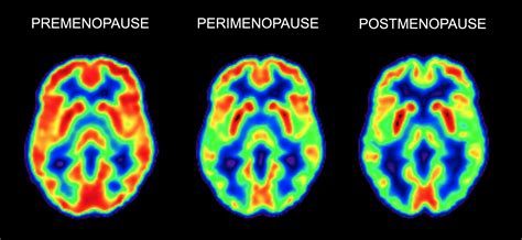 The Link Between Menopause and Alzheimer’s - WSJ