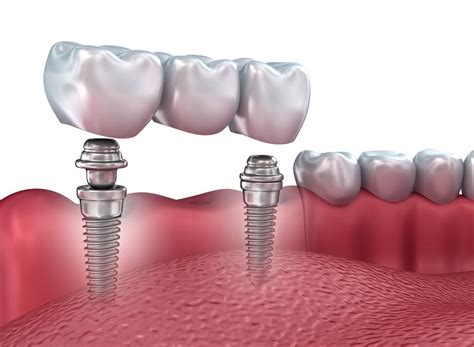 Colocación de un implante dental paso a paso Clínica Larrañaga