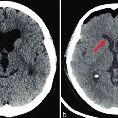 A Preoperative Axial Computed Tomography Ct Demonstrating