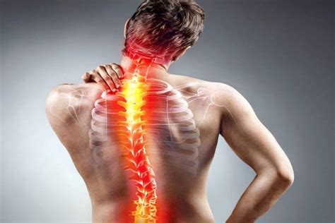 Hernia discal Qué es síntomas signos y tratamiento de fisioterapia