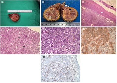 Macroscopic Appearance Of The Resected Tumor And Pathology Results A