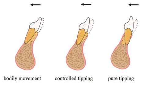 Augmented Corticotomy On The Lingual Side In Mandibular Anterior Region