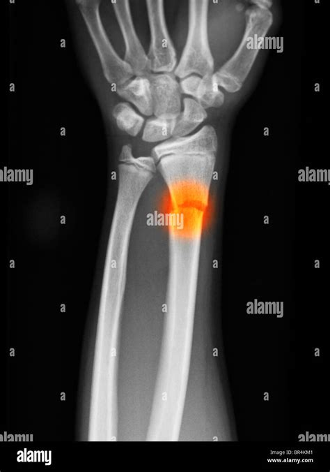 Antebrazo X Ray Mostrando Una Fractura De Radio Distal En Un Muchacho