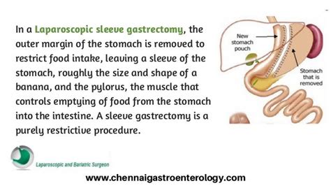 Laparoscopic sleeve gastrectomy in Chennai | Laparoscopic Surgeon Chennai