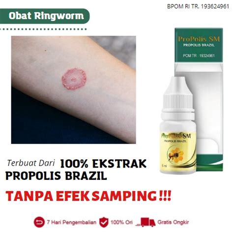 Jual Propolis SM Obat Ringworm Manusia Infeksi Kulit Jamur Ruam