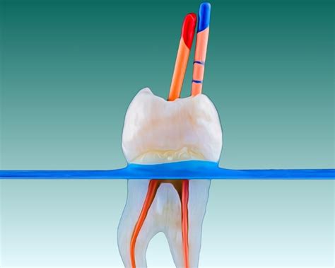 Root Canal Treatment | Side Effects, Reviews & Prices 2025