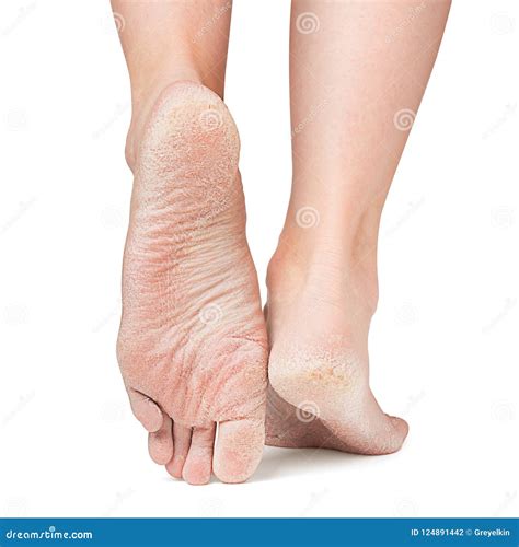 Sore Skin of Feet, Crack, Dry Heels Stock Photo - Image of heels