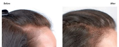 Prp For Thinning Hair In Jacksonville Beach And Ponte Vedra