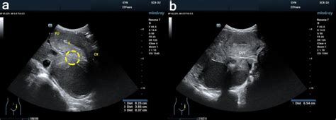 24-year-old female with cystic degeneration of uterine fibroid ...