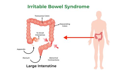 Irritable Bowel Syndrome Wikipedia