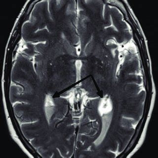 MRI showing persisting ventriculitis with hydrocephalus | Download ...