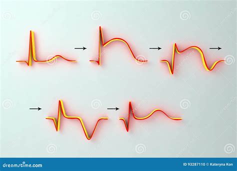 Ecg I Myocardial Infarkt Illustrationvisningevolution Av Ecg Med Tid