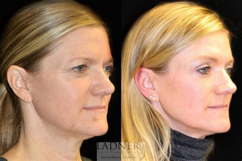 Eyelid Surgery Blepharoplasty Before And After Pictures Case 20 Denver Co Ladner Facial