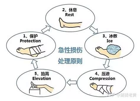 辟谣：崴脚之后一定要冰敷24小时吗？医生教你4招科学康复 知乎