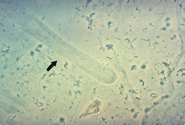 Hyaline Casts In Urine / Microscopic Analysis of Urine | Faculty of ...