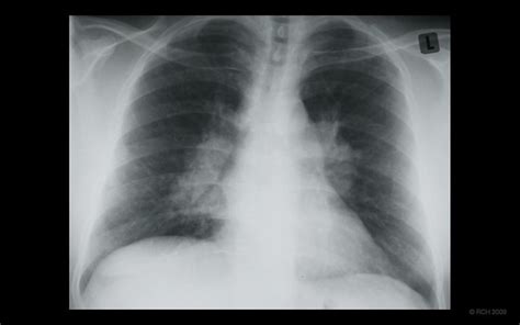 Med 5 Talk Chest 2 - CT: Mediastinal and hilar lymphadenopathy from sarcoidosis, CXR AP | Flickr ...