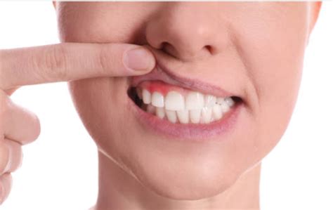 Gingivitis Qué es y cómo puedes prevenirla Clínica dental Gil