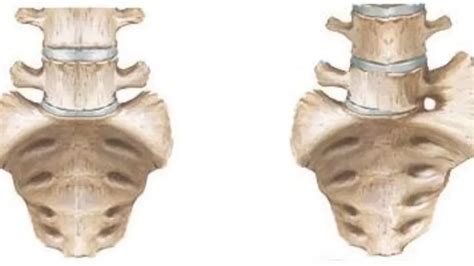 sacralization of l5 treatment Archives - Samarpan Physiotherapy Clinic ...