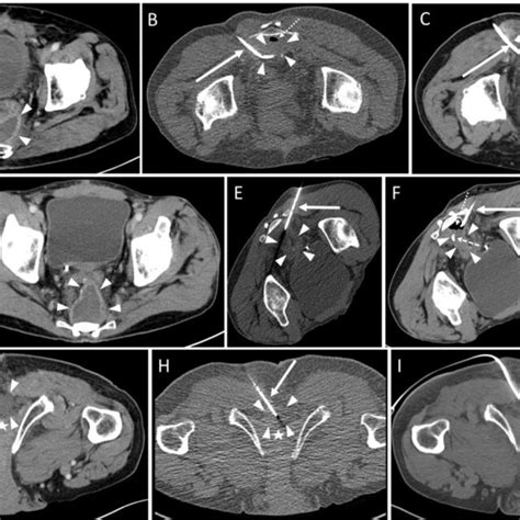 Pdf Low Dose Ct Fluoroscopy Guided Drainage Of Deep Pelvic Fluid