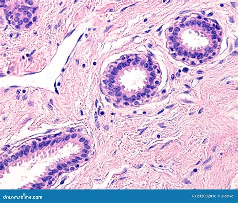 Human Breast Gland Adenosis Stock Photo Image Of Adenosis