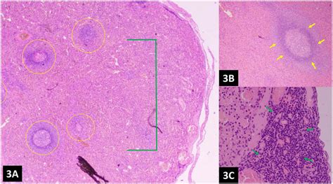 A C Histopathology Of The Omental Nodules Reveals Normal Splenic Download Scientific Diagram