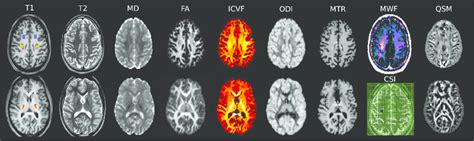 Mri Protocol For This Study T Weighted Mprage Image T Left In Two