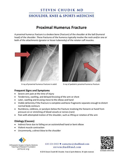 Proximal Humerus Fracture - Steven Chudik MD