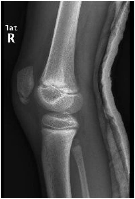 Lateral Radiograph At Presentation Showing Inferior Pole Fragment