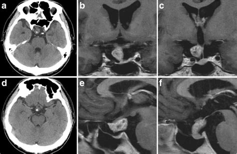 Preoperative Ct Scans A D Showing A Suprasellar Iso Density Mass