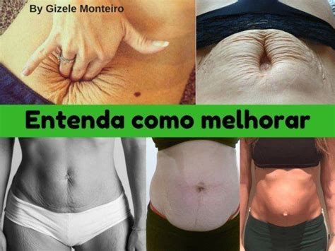 O que fazer e quanto custa tratar a barriga após a gravidez Gizele