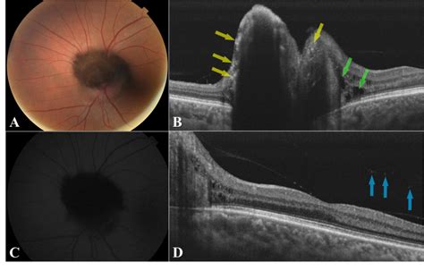 Optic Disk Melanocytoma And Optical Coherence Tomography Angiography Oct A Eyewiki