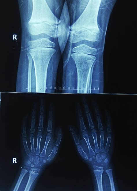 Anteroposterior View Of Knee And Bilateral Wrist Radiograph Download Scientific Diagram