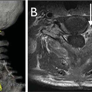 A Postoperative Axial Gd Enhanced T1 Weighted MR Image At The C7