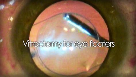 Elimination of eye floaters with vitrectomy eye surgery