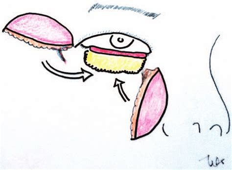 Operative procedure 3. the scapha cartilage graft is placed higher in ...